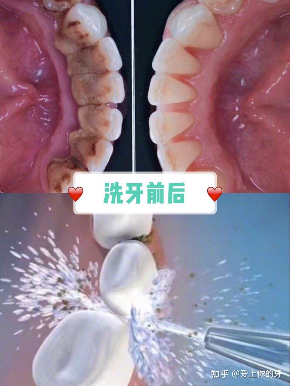 三门峡洗牙可以用医保吗(洗牙可以用医保吗,报销比例多少)